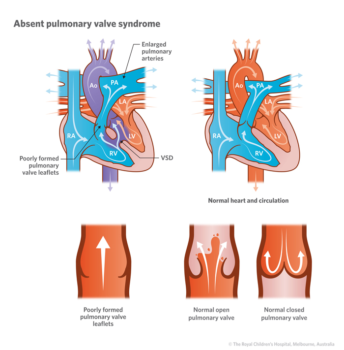 1a_Absent pulmonary valve syndrome.jpg